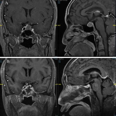 Perioperative hormone level changes and their clinical implications in patients with pituitary adenoma: a retrospective study of 428 cases at a single center